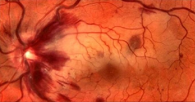 Blutgefäße der Retina und Vision Restoration